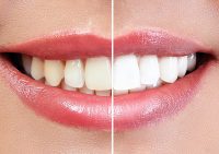 Zoom Whitening Dentist Central HK